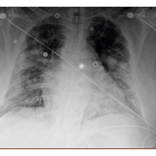 Chest X Ray On Day 14 Showing Worsening Bilateral Infiltrates