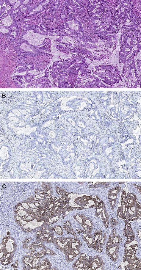 Application Of Immunohistochemistry And Molecular Diagnostics To