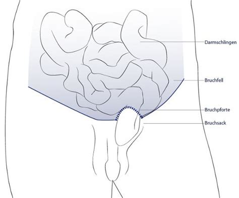 Leistenbruch Leistenhernie Op Behandlung Info Medizin