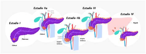 Stages Of Pancreatic Cancer