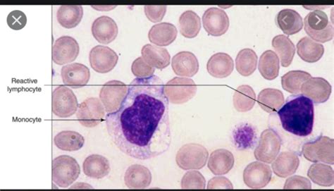 Reactive Lymphocytes Vs Monocytes