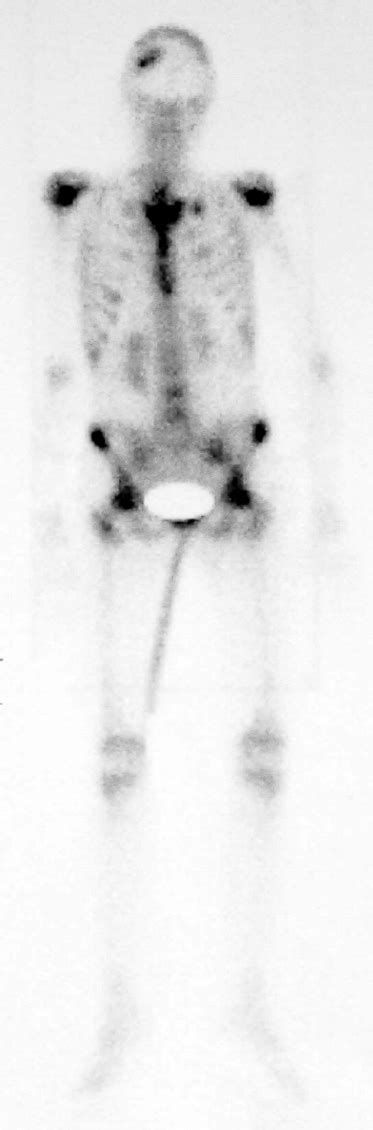 Technetium Methylene Diphosphonate Tc MDP Bone Scintigraphy At