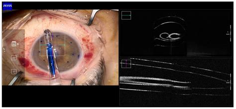 Challenges Of Dmek Technique With Young Corneal Donors Grafts