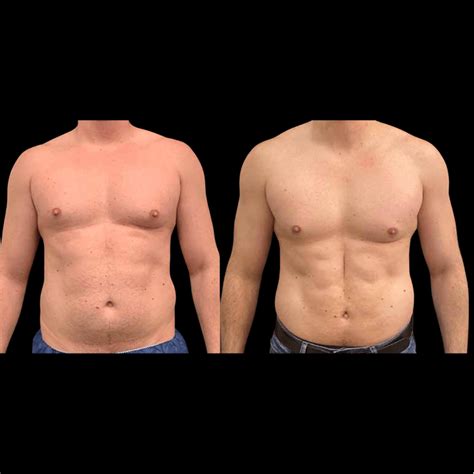 Before And After Male Liposuction Results Neinstein Plastic Surgery