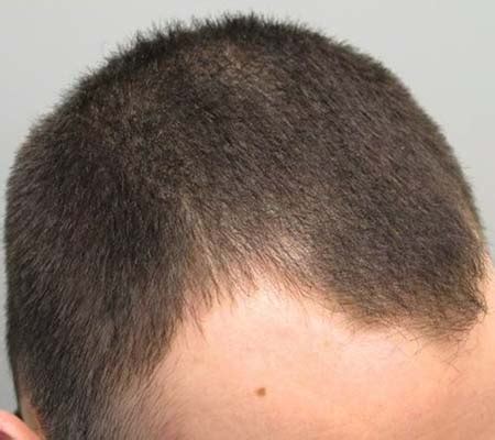 Mens Hair Loss Treatment Dr Health Clinic Homepage