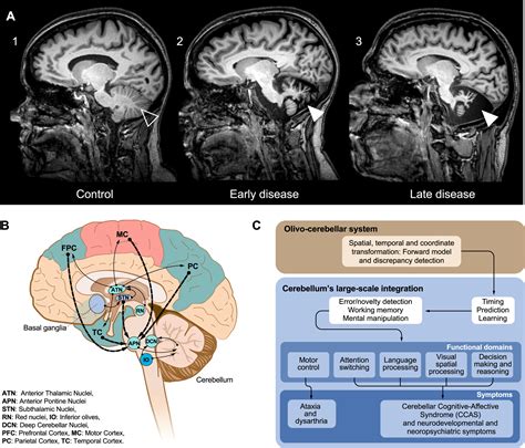 gm gangliosidoses unlocking  mysteries  pathogenesis