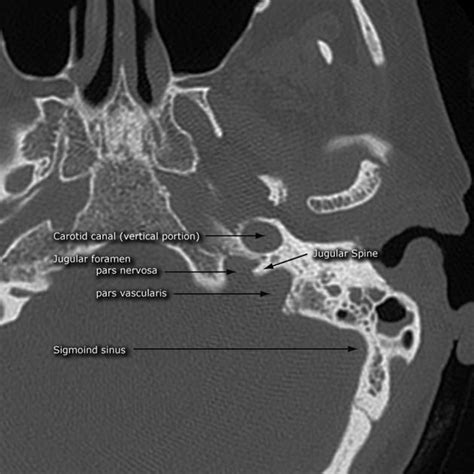 Jugular Foramen Radiology Reference Article Ear