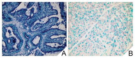 Diagnostic And Biological Significance Of MicroRNA 192 In Pancreatic