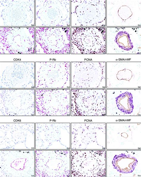 Immunohistological Staining Of Distinct Cdks And P Rb Activation In