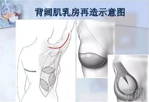 乳房重建多样选择 重塑女性之美 蜜颜优惠