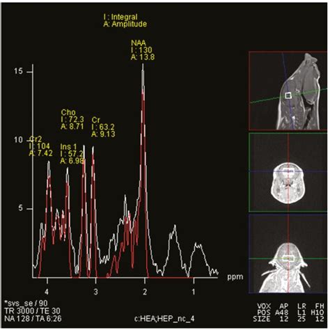 Representative Single Voxel Spectroscopy Spectrum Single Voxel