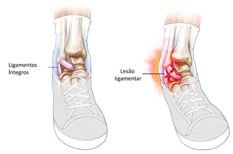 Contus O Entorse Luxa O E Fratura Qual A Diferen A