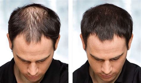 Hair Loss Treatments How Effective Are They A Diy Projects