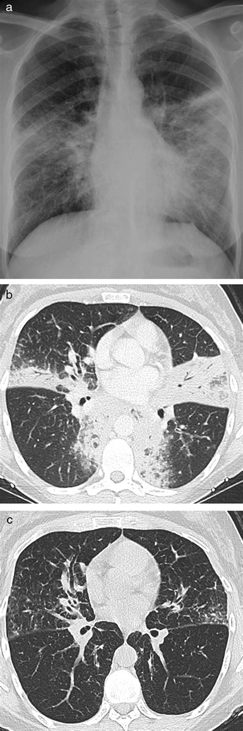 Igg4 Related Lung Disease Three Untreated Cases With A Benign Outcome