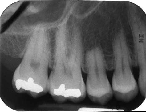 External Resorption – Dr. G's Toothpix