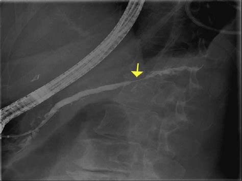 Pancreatoscopy Guided Laser Dissection And Ablation For Treatment Of Benign And Neoplastic