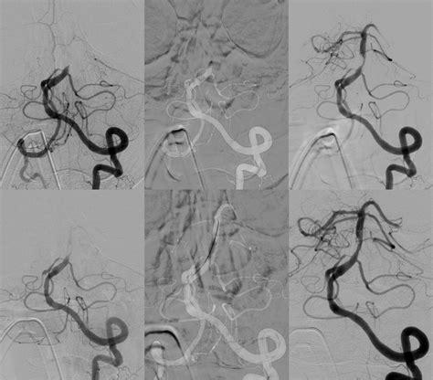 Significance Of Angiographic Clot Meniscus Sign In Mechanical