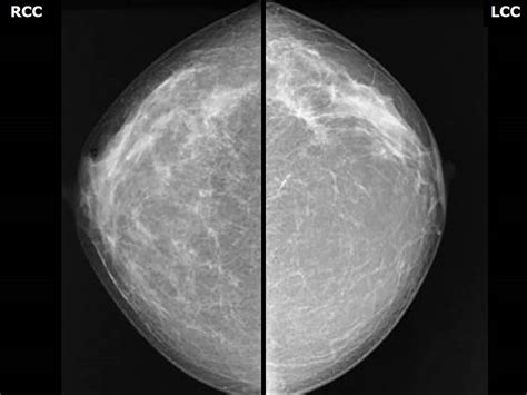 Atlas Of Breast Cancer Early Detection