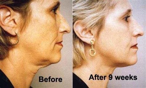 Exercises To Tighten Neck Skin Achieve A Taut And Youthful Look