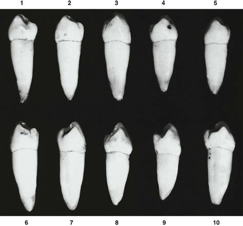 10 The Permanent Mandibular Premolars Pocket Dentistry