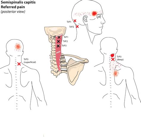 Dry Needling Therapy...Neck Pain & Headaches - CPD Health Courses Dry Needling Training