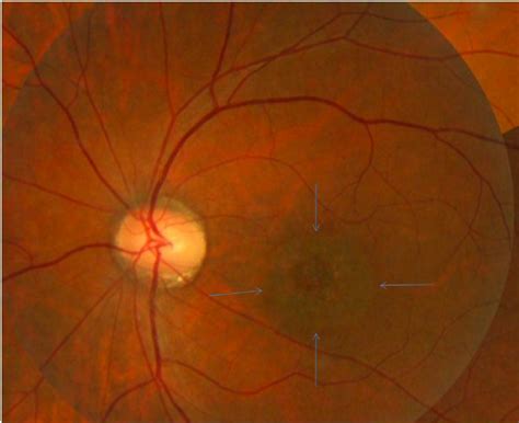 Fundus Photograph Of A Year Old Boy With Progressive Cone Dystrophy