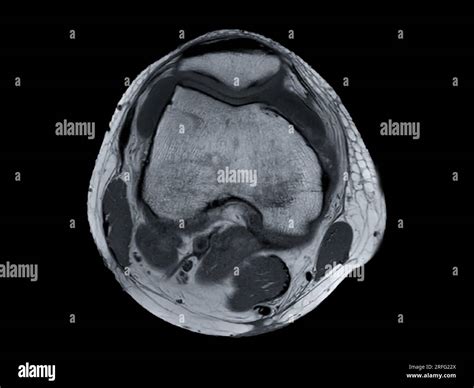 Imagerie Par R Sonance Magn Tique Ou Irm De L Articulation Du Genou Vue