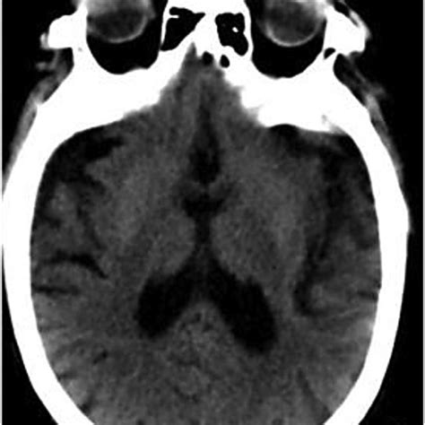 (PDF) Bilateral striatum with high-signal intensity on T1-weighted MRI: A case of hemichorea ...