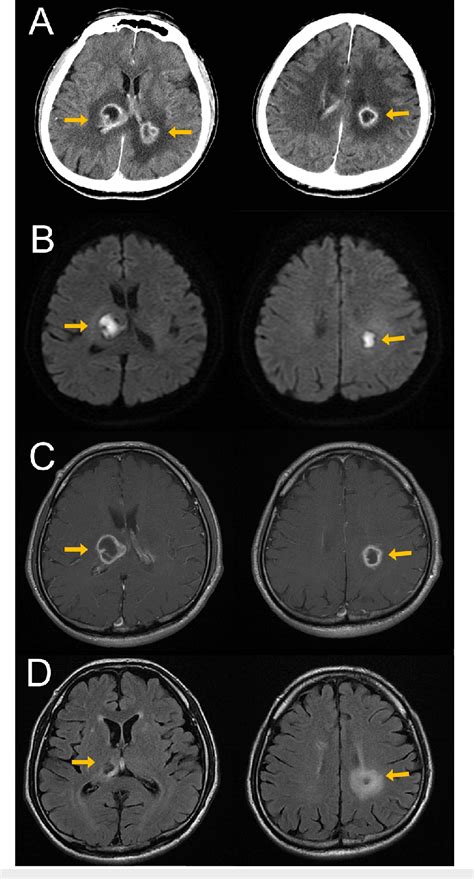 [PDF] Focal Neurological Symptoms at Initial Presentation Could Be a ...