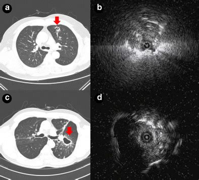 Radial Probe Endobronchial Ultrasoundguided Transbronchial Lung Biopsy