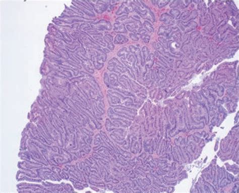A Villous Architecture 4x B Glandular Architecture Of Nonurachal