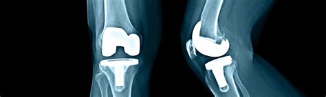 Proth Se Unicompartimentale De Genou Chirurgie Orthopedique Valence