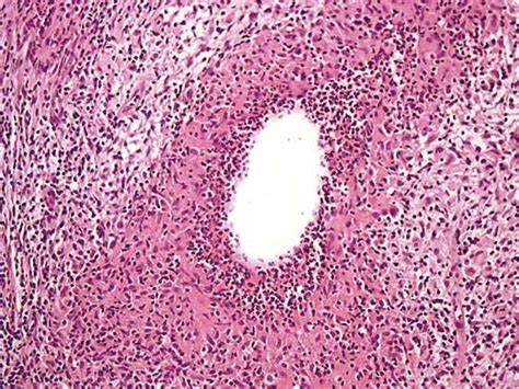 Case Of IGM Showing Cystic Neutrophilic Vacuoles Rimmed By Neutrophils