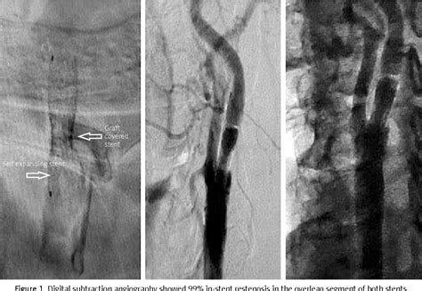 Figure 1 From In Stent Graft Restenosis In The Carotid Artery What Is