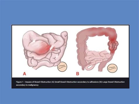 Acute Strangulated Intestinal Obstruction Bhadra Pptx