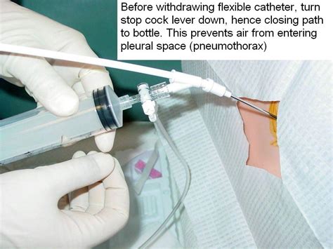 Clinical Notes: Thoracentesis: A Step-by-Step Procedure Guide with Photos