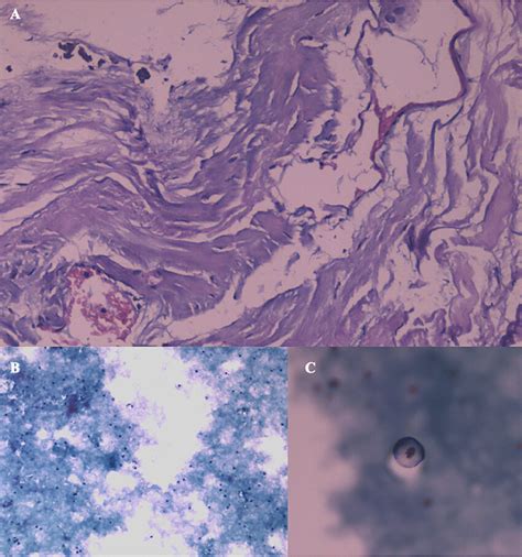 Pathologic findings. A Meningeal biopsy with inflammatory changes and ...