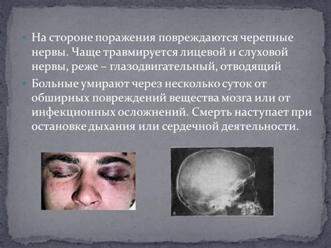 Презентация "Перелом основания черепа" – скачать проект