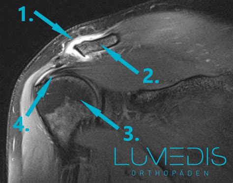 Mrt Der Schulter Lumedis Ihre Schulterspezialisten