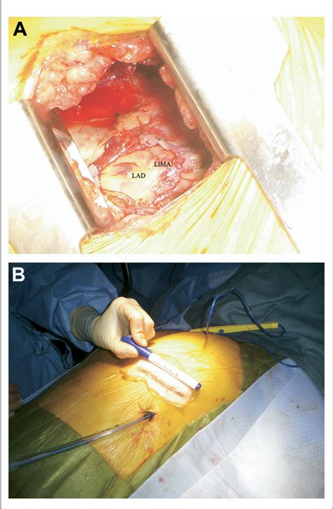 Figure 1 From Hybrid Cardiovascular Procedures Semantic Scholar