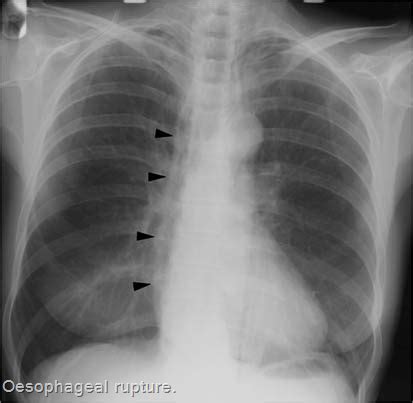 Esophageal Perforation - Stepwards