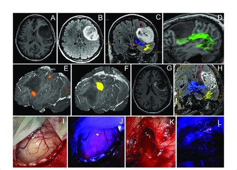 Case A Year Old Man With The Left Frontal Anaplastic Astrocytoma