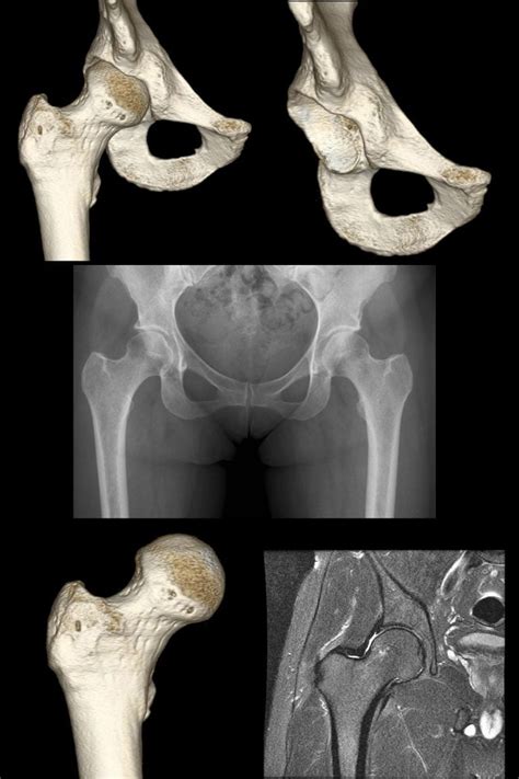 Radiologia Do Quadril