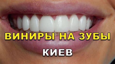 Виниры на кривые зубы Киев (Украина) видео - Люми-Дент (Вініри на зуби ...