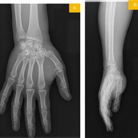 Posteroanterior A And Lateral B View Radiographs Of Wrist Showing