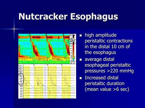 Nutcracker Esophagus Manometry