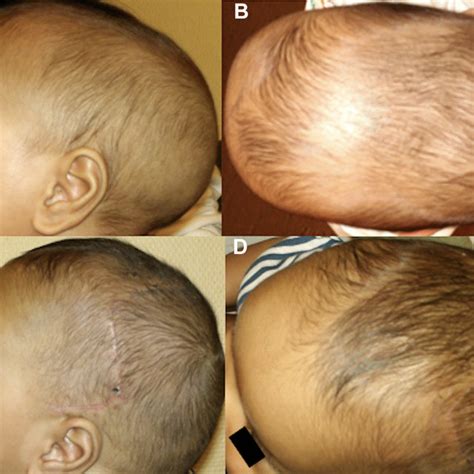 Pictures Of A Patient Presenting A Non Syndromic Metopic Synostosis At