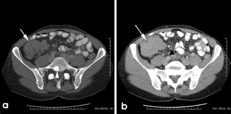 A Imaging Shows A Well Defined Caecal Tumour Arrow With Evidence Of