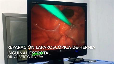 Reparación Laparoscópica De Hernia Inguino Escrotal Youtube