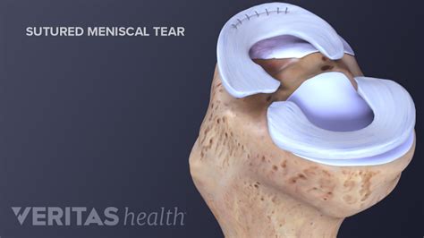 Meniscal Tear Treatment | Sports-health